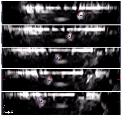 Figure 7. Tracking error calculation as a difference of the circle CoM (red crosses) and the CoM calculated from the algorithms (blue points). In this evaluation stage, the endovascular device is moved back and forward along the path. The CoM tracking error is reported in the image for three different subsequent timings. For a clearer visualization, only the US plane 1 is showed in figure.