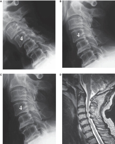 Figure 1. An 84-year-old man with C4/5 myelopathy. A, B, and C: Plain X-ray (A: flexion position, B: neutral position, and C: extension position). In the flexion position, 2-mm anterior slippage in C3 and 3-mm anterior slippage in C4 are demonstrated (A). In the extension position, C3 anterior slippage is reduced, and C4 anterior slippage is 1 mm (C). Space available for the spinal cord at C4/5 in the flexion and extension positions is 12 and 15 mm, respectively. C5-7 range of motion and lordosis angles are 3° and 4°, respectively. D: MRI showed spinal cord compression at C3/4 and C4/5. E and F: CT after myelography (E: flexion position and F: extension position). In the flexion position with maximum anterior slippage and osseous stenosis, deformation due to spinal cord compression is not confirmed (E). In the extension position with minimum anterior slippage and osseous stenosis, findings indicative of spinal cord compression from the posterior direction due to the buckling of the ligamentum flavum are confirmed (F).