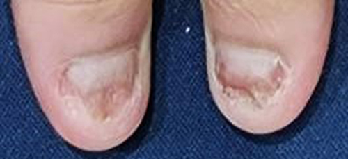 Figure 3 Following two PDL treatments, a significant and sustained improvement has been observed in both thumbnails and periungual skin.