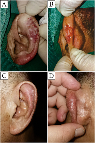 Figure 2 After the incision is subjected to an apposition suture, a modified through and through suture is performed with collagen sutures (A and B). One month after the operation, reexamination shows that the auricle recovers well (C and D).