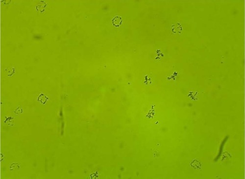 Figure 10 Clumping of lactobacilli with semicircular ridge formation.