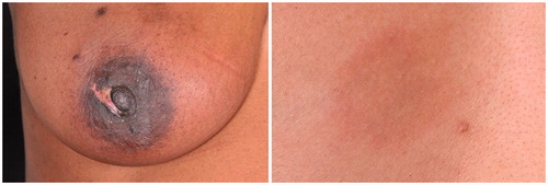 Figure 6. Complications recorded during the study (l) skin burn at 2 weeks and (r) hyperpigmentation at 3 months.