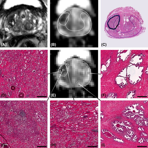 Figure 1. Patient example, showing voxels with an ADC ranging from 0.781 to 1.83 × 10−3 mm2/s and the corresponding microanatomy. A) T2w image, B) high resolution ADC map with delineation of tumour and peripheral zone, C) corresponding H&E section with delineations of a tumour with Gleason score 3 + 4 = 7 and the peripheral zone (thin line). On the low resolution ADC map in E) several voxels are selected of which the corresponding microanatomy is shown in D) and F–I). D) and H) tumour voxels with Gleason grade 3. G) tumour voxel with Gleason grade 4. F) and I) voxels with normal peripheral zone tissue. Benign voxels have apparent lower cell density and more glandular area. Bars: 200 μm.