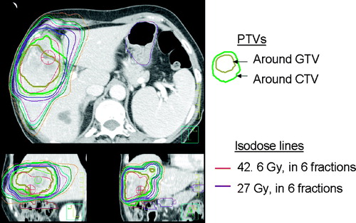 Figure 3.  Radiotherapy plan for a patient with liver metastases treated with 42.6 Gy in 6 fractions. Effective liver volume irradiated was 35%. Planning target volumes (PTVs) around the gross tumour volume (GTV) and clinical target volume (CTV) shown with corresponding isodose lines.