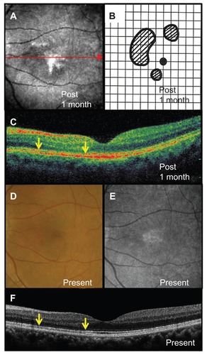 Figure 2 Photographs at 4 weeks after systemic corticosteroid therapy (A–C) and at the final visit (D–F): (A) reduction of the dark area visible by scanning laser ophthalmoscope and (B) scotomata in the Amsler chart; (C) improvement in the disruption of the inner segment–outer segment junction (indicated by arrows) on optical coherence tomography (indicated by arrow of figure 2A); (D) the lesion and (E) dark area visible by scanning laser ophthalmoscope almost resolved with further recovery of (F) the inner segment–outer segment line (indicated by arrows) on optical coherence tomography.