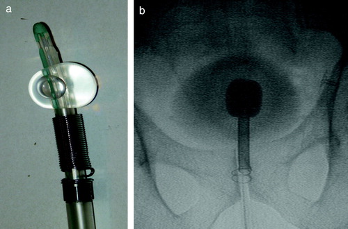 Figure 2.  a) The DS-II stent mounted on insertion kit and Foley catheter with balloon inflated. b) Flouroscopy image from insertion. The foley catheter s inflated with contrast media. The bladder is filled with diluted contrast media to give the contour of the bladder. The insertion kit has been pushed forward until the upper end of the stent touches the Foley catheter balloon. The distance from the lower end of the stent to the caudal part of the pubic has to match the measure from the diagnostic MR scan. The catheter has been flushed with hot water and the stent collar has expanded and locked the stent position in the prostate.