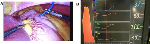 Figure 1 (A–B). Transserosal microcirculation recordings: (A) microprobe on ventricle surface (B) LCD monitor with the real-time absorption spectrum of oxyhemoglobin (red), and graphic presentation of StO2, relative hemoglobin, flow and velocity and the mean numerical values.