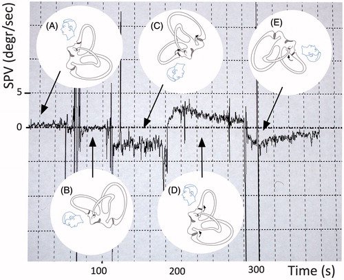 Figure 1. Example of vertical slight, persistent positional nystagmus evoked by symmetrical positioning during PAN I. (A) Sitting position. This position has been maintained for a longer time before the measurements therefore the vertical semicircular cupulae are already deflected upward and adapted to this situation. (B) From sitting to 30° prone (no nystagmus because the position of the vertical cupulae does not change), (C) from 30° prone to head-hanging prone (upbeat nystagmus because of the deflection of the anterior and posterior cupulae (curved arrows)), (D) from head-hanging prone to sitting (downbeat nystagmus for over 100 s), and (E) from sitting to supine: again upbeat nystagmus (because of the deflection of the anterior canal cupula).