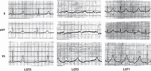 Figure 7. ECG manifestations of subtypes of long QT syndrome. Left: Type 3 long QT with the characteristic late onset of the T wave. Center: Type 2 long QT showing a biphasic T wave (i.e. U wave fused to the end of the T wave). Right panel: type 1 long QT with ‘giant’ broad T wave. Paper speed 25 mm/s, gain 10 mm/mV. Reprinted with permission from Moss AJ et al. ECG T-wave patterns in genetically distinct forms of the hereditary long QT syndrome. Circulation. 1995;92:2929–34. Wolters Kluwer Health. ©