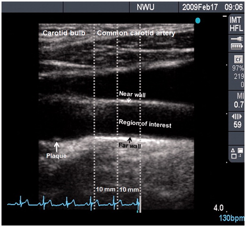 Figure 1. B-mode ultrasound image of the left carotid artery, indicating the carotid bulb (on the left) and common carotid artery (on the right). The region of interest, where intima–media thickness was measured, is a 10 mm segment of the common carotid artery located 10 mm distal to the carotid bulb. All measurements were taken at full arterial dilation (R-wave). This image was obtained from a defensive coping African male with a mean carotid intima–media thickness of 0.77 mm and a plaque score of 2, indicating a small and isolated thickening.