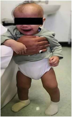 Figure 1. Child presented with alopecia, frontoparietal bossing, and bowlegs