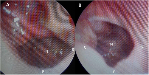 Figure 4 Nasal endoscopy images of the right (A) and left (B) nasal cavities 5 weeks post-op show patent choanae bilaterally.
