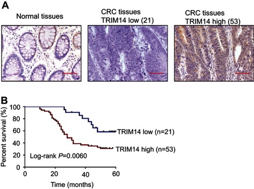 Figure 1 Protein expression of TRIM14 in colorectal cancer (CRC). (A) TRIM14 protein expression in 74 CRC tissues were assessed byimmunohistochemistry (IHC) analysis. Noncancerous tissue samples were used as control. Scale bar: 50 μm; (B) Kaplan–Meier curves for overall survival of patients with CRC categorized according to TRIM14 expression.