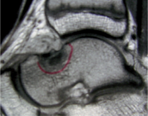 Figure 6. Case 2. The talar osteoid osteoma. Appearance on an MRI view.