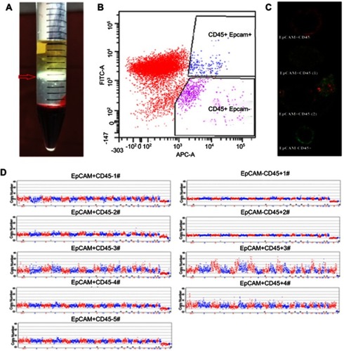 Figure 1 Sample processing and CTC detection. Blood mononuclear cells (BMCs) and CTCs were isolated by density gradient centrifugation (A). EpCAM+ and CD45- cells identified by flow cytometry were considered tumor cells (B). Cells from different regions were identified by laser confocal microscopy (EpCAM-APC: Red: CD45-Alexa Fluor® 488: Green) (C). Cells randomly isolated by flow cytometry from the EpCAM+ CD45- region and the EpCAM+CD45+ region of one specimen were manually separated by micropipetting under a microscope, after which individual cells were subjected to whole-genome amplification to detect copy number variation (CNV) profiles. The copy numbers are segmented (blue and red lines) (D).
