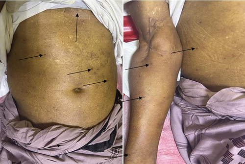 Figure 1 Demonstrates multiple red raised dermal papules (bee stings) on the anterior abdominal wall and right upper extremity.