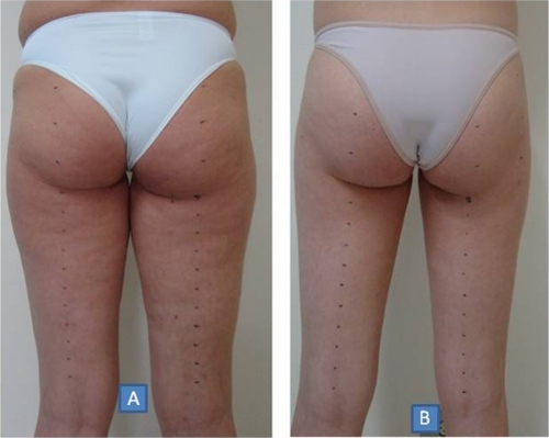Figure 1A and 1B. Pretreatment and post-treatment of the gluteal fold and thighs.