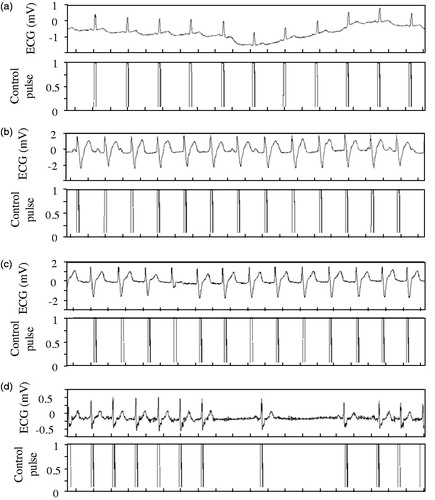 Figure 5. Data processing results for the four typical ECG signals (a) Normal sinus rhythm (Record 121) 0.2s/div; (b) Paced sinus rhythm (Record 107) 0.2s/div; (c) Atrial fibrillation (Record 217) 0.2s/div; (d) SA conduction disturbance (Record 232) 0.2s/div.