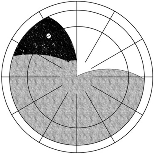 Figure 1 Group 1: detachments that occurred in the temporal or nasal superior region and did not exceed 12 o’clock.