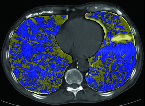 Figure 4  Computer-aided comparison of the extent of emphysema before and after smoking cessation. The lung contours are first defined and subsequently aligned. Digital subtraction of the images with colour coding shows the abundance of areas with fall in lung density (blue) in comparison to areas with increase in lung density (yellow) (Citation31).