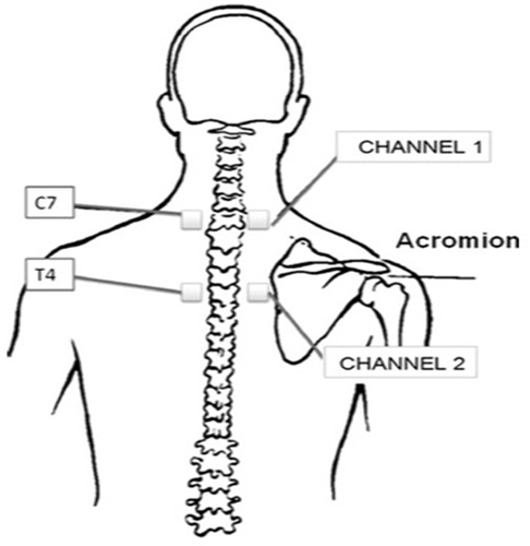 Figure 1 Diagram showing the location for application of the transcutaneous electrical nerve stimulation.