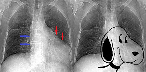 Figure 3 The scout film of CT exhibiting the snoopy sign, which is characterized by a leftward and posterior displacement of the heart as well as an elongation and straightening of the left heart border (red arrows). The right cardiac border is also absent (blue arrows).