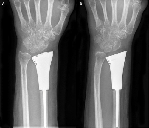 Figure 7 (A) One-month postsurgical posteroanterior radiographs; (B) posteroanterior radiographs also were obtained 10 months after surgery. There were no significant degenerative changes.