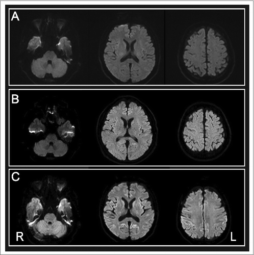 Figure 1. Brain diffusion-weighted magnetic resonance images obtained at (A) one month, (B) 7 months and (c) 18 months after onset.
