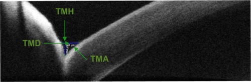 Figure 2 Tear meniscus parameters as measured by AS-SD-OCT.
