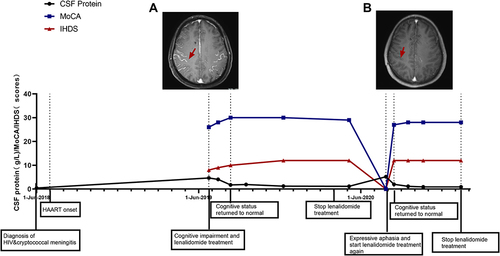 Figure 2 Timeline for Case 2. (A) Axial cerebral magnetic resonance imaging (MRI) in T2-weighted sequences before lenalidomide treatment: the red arrow shows multiple regions of thickening and enhancement in the meninges. (B) Axial cerebral MRI: the red arrow shows the degree of meningeal enhancement was significantly reduced after lenalidomide treatment.