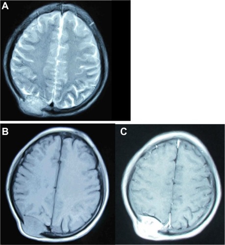 Figure 2 MRI of cranial bones.