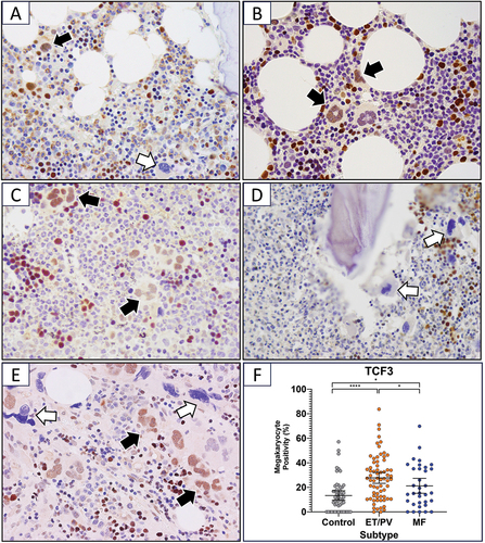 Figure 1. Quantitative and qualitative assessment of TCF3 expression in megakaryocytes of MPN (ET/PV = 68, MF = 34) and control bone marrow trephines (n = 71). (A–E) Immunohistochemical staining showing TCF3 in bone marrow trephines of normal marrow and MPN subtypes. Black arrows indicate examples of TCF3-positive and white arrows TCF3-negative megakaryocytes. Positive erythroid, granulocyte and lymphoid cells are present in all cases. A) control bone marrow (x600); B) ET (x600); C) PV (x600); D) MF with distorted TCF3-negative megakaryocytes adjacent to trabecular bone (x400); E) MF that arose secondary to preceding ET. The interstitial megakaryocytes are positive and have a morphological appearance as seen in B). The TCF3-negative megakaryocytes are angulated with pyknotic nuclear chromatin, a feature of MF (x400). (DAB substrate; hematoxylin counterstain.) F) percentage of megakaryocytes expressing TCF3 in control, ET/PV and MF patients (Kruskal–Wallis one-way ANOVA analysis followed by Benjamini–Hochberg adjustment). Data shown as the mean ±95% confidence interval. *padj < 0.05, **padj < 0.01, ***padj < 0.001, ****padj < 0.0001.