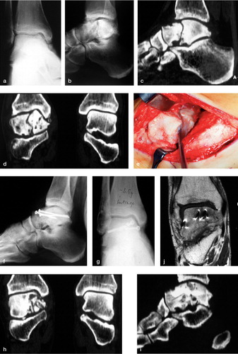 Figure 1. Reconstruction of a displaced talar nonunion (type II deformity). A 50-year-old man presented with a talar non-union and displacement at the ankle joint posterior to the talar neck (a-d) 4 years after a bicycling accident. The fracture had been overlooked initially. Treatment consisted of debridement of the pseudarthrosis (e), bone grafting from the ipsilateral iliac crest and screw fixation (f, g). CT-scanning after surgery showed a congruent joint reconstruction (h, i). MRI at 5 months after surgery showed no signs of AVN (j). At follow-up after 2.5 years, the patient was pain free and had normal function of the ankle and subtalar joints. Weight-bearing radiographs showed no AVN or progression of arthritic changes as compared to the preoperative radiographs (k-m).