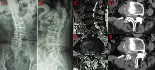 Figure 4 Imaging images of an 83-year-old DLS patient with L4/5 as the responsible segment. (A and B) X-rays showing degenerative deformity of the patient’s lumbar spine. (C and E) Preoperative lumbar MRI (Magnetic Resonance Imaging) showed severe spinal stenosis. (D and F) Axial CT (Computed Tomography) images of the lumbar spine show adequate decompression.