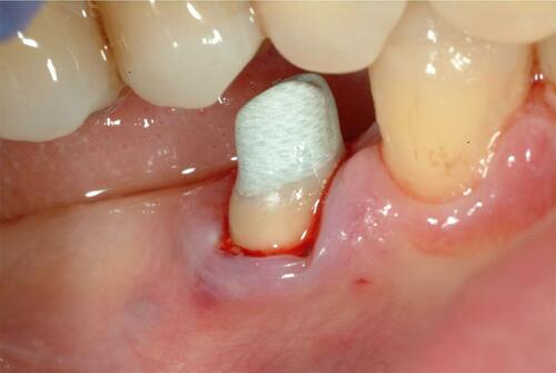 Figure 5 Intraoral vision of post and core after adhesive cementation.