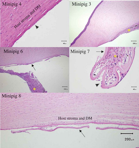 Figure 3. Examples of histological findings Top left: One month after endothelial removal in minipig 4 by scraping histology revealed endothelial cells present in the same area. Top right: Minipig 3 showed fibrosis with angiogenesis on the posterior cornea after descemetorhexis. Middle left: Fibrosis in the anterior chamber (minipig 6). Middle right: Fibrotic reaction around a partially detached HALC (minipig 7). Endothelial cells can be seen on the HALC. Bottom: Reactive changes and cellular infiltration between HALC and host cornea . No endothelial cells can be seen on the HALC (minipig 8). Arrow head = endothelial cells, arrow = human anterior lens capsule (HALC), asterisk = fibrosis DM = Descemet’s membrane
