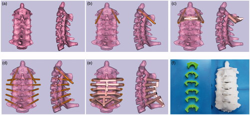 Figure 1. The construction workflow of rapid prototyping navigation template. (a) The coronal and sagittal plane of 3D models of C2–C7. (b) The confirmation of C2 channels to ensure that pedicle screw pass through the center of pedicle without penetrating the cortical bone. (c) The design of navigation template of C2 via the location of screw channels. (d) The confirmation of C3–C7 pedicle screw channels. (e) The design of navigation template of C3–C7 via the location of corresponding screw channels. (f) The physical navigation template and vertebra model.