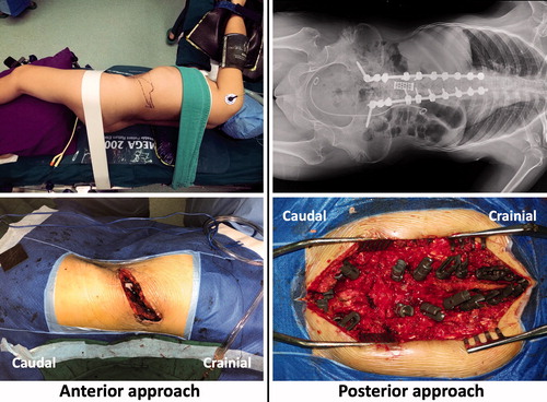 Figure 3. Case 2: Osteotomy and pedicle screw fixation were performed via a posterior approach and a mesh was inserted via an anterior approach during a single procedure.