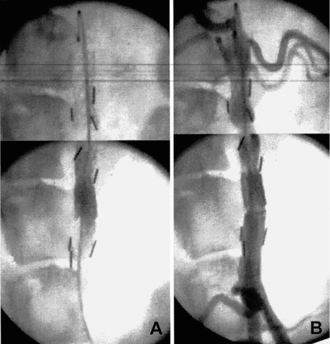 Figure 11 Angiographies recorded before the sacrifice of a dog whose stent-graft was implanted for 6 months, in the absence of contrast agent (A) and in the presence of contrast agent (B).