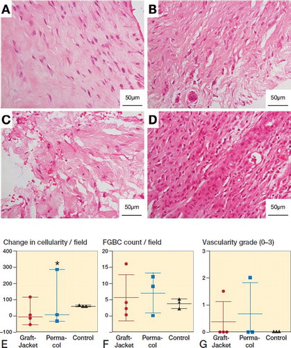 Figure 2. Representative histology showing tissue response to patch augmentation compared with control (no patch) group. A–D: Typical 4-week biopsy sections stained with hematoxylin and eosin (H&E) for control (A), GraftJacket (B), and Permacol (C) patch augmentation, showing increasing disruption of the tendon extracellular matrix (ECM). D: Abnormal tissue response from patient receiving Permacol showing dense infiltration of immune cells. E–G: Histology results comparing 3 groups (GraftJacket, Permacol, and Control) for change in cellularity (E), foreign-body giant cell (FBGC) count (F), and vascularity grade (G). * symbol denotes the patient receiving Permacol with grossly different tissue response.