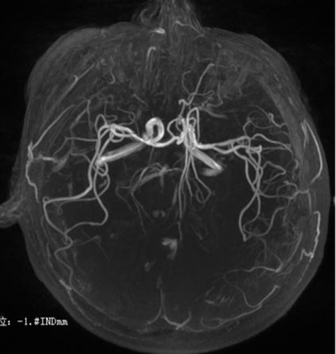 Figure 3 Magnetic resonance angiography demonstrating patent basilar artery and posterior cerebral arteries.