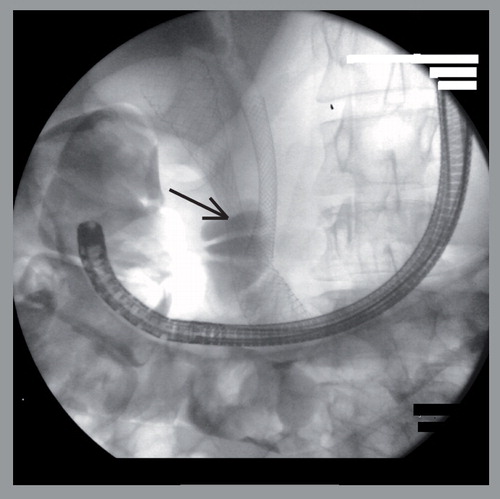 Figure 1. Fluoroscopic image showing a combination of biliary and duodenal (arrow) metal stent placement for the palliation of advanced pancreatic cancer.