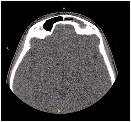 Figure 9. The axial section shows opacification and atelectasis in the left frontal sinus.