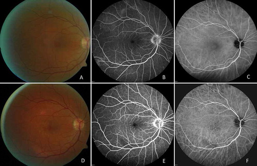 FIGURE 1. (A) Color photograph of the right eye. (B) Fluorescein angiographic image. (C) indocyanine green angiographic image before treatment: slight dye leakage at the optic disk, small foci of inflammation at the periphery. (D) Color photograph. (E) Fluorescein angiographic image. (F) Indocyanine green angiographic image after 6 months of treatment: decreased severity of inflammation.