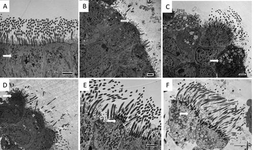 Figure 2. Legend: transmission electron microscopy (TEM) images of ciliated respiratory epithelium from a healthy ex-smoking control subject (A) showing normal mitochondria (arrow), and a patient with COPD (B–F) showing significant loss of cilia (B), abnormal mitochondria (C), projecting cell (D), cytoplasmic bleb (E) and dead cell (F). Internal scale bar = 2 µm.