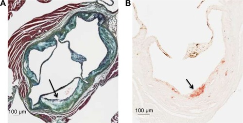 Figure 2 Representative examples of the histology of an atherosclerotic lesion within the aortic sinus in apoE−/− mice at 45 weeks of age (control group).