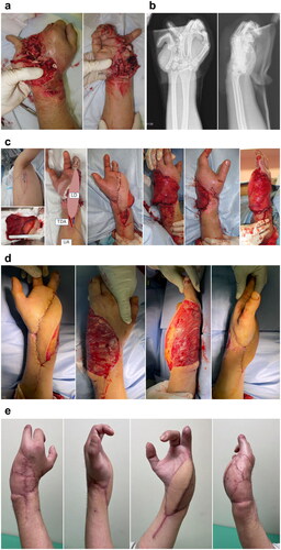 Figure 3. (A) Appearance on his arrival. (B) Radiographic examination on his arrival. (C) Free LD flap was performed at 1 week after injury. The recipient artery was sutured end-to-end to the ulnar artery. (D) After the third tangential excision, (E) Findings at 3 months after free LD flap. LD: latissimus dorsi.