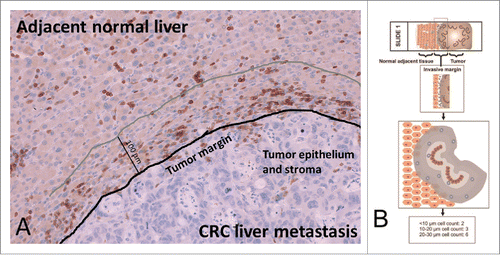 Figure 1. (A) Representative invasive margin of a CRC liver metastasis with annotations (CD3 positive lymphocytes appear dark brown). (B) The invasive margin of liver metastases is analyzed separately, encompassing 100 µm into normal adjacent liver from the tumor epithelium. Shaded areas highlight distinct distance classes of 10 µm in relation to the tumor epithelium.
