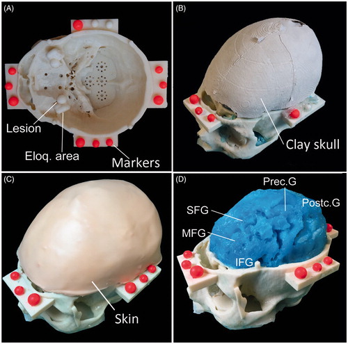 Figure 5. Patient-specific head phantom. A) The skull base is embedded with bilateral frontal lesions both medial to the adjacent eloquent areas (Eloq. area). The inner surface of the skull base presents several housing designed to insert further lesions or eloquent areas. Four lateral shelves served as support for optical reference markers (fluorescent dyed spheres). B) The skull clay vault. C) The liquid polymer used to reproduce the brain was spilled in a complete skull model. After removing the vault, brain perfectly reproduced the details of gross superficial cerebral parenchyma, including: inferior frontal gyrus (IFG), middle frontal gyrus (MFG), superior frontal gyrus (SFG), precentral gyrus (Prec. G), postcentral gyrus (Postc. G.). D) The complete phantom with the vault covered with a skin-like silicon layer.