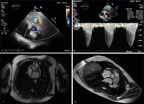 Figure 1 Multimodality imaging evaluation of PS. (A) PSAX view with Color Doppler showing flow turbulence in RVOT*; (B) CW Doppler of severe PS; (C) Reduce PV opening† on SSFP cine imaging; (D) PA trunk dilatation with flow turbulence due to Jet lesion.